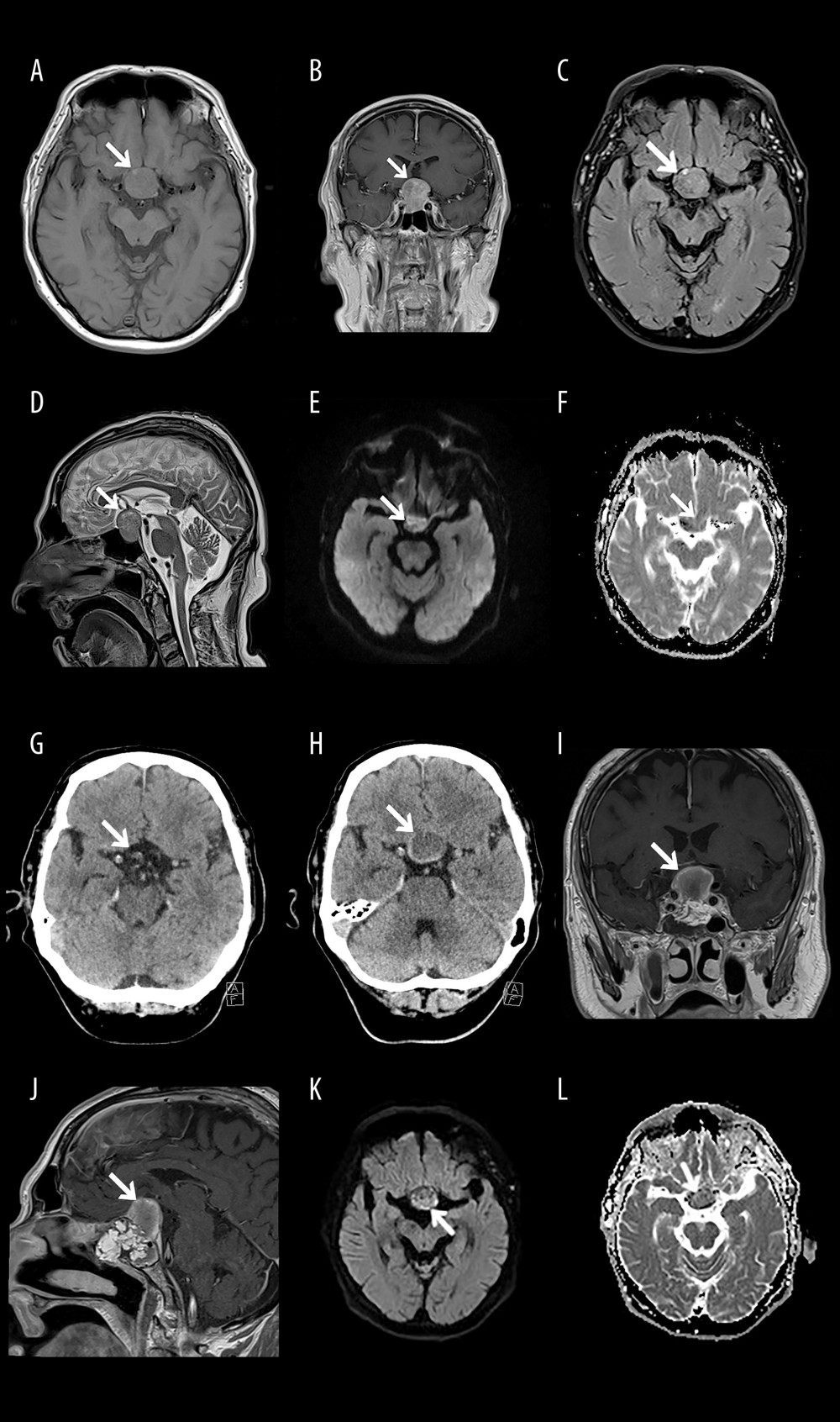 (A–F) Preoperative magnetic resonance imaging (MRI) examination of pituitary abscess in the setting of a pituitary adenoma. Transverse unenhanced (A) and coronal T1-weighted images after gadolinium administration (B) show a 30×25×23 mm solid contrast-enhancing sellar mass with expansion into the suprasellar cistern and the sphenoid sinus. The mass compresses the optic chiasm, the bottom of the third ventricle, displaces the pituitary infundibulum and the pituitary gland. The lesion is isodense on T2-weighted dark fluid sequence, except of a hyperintense part measuring 4×4×10 mm in the upper part of the lesion (C). T2-weighted sagittal image shows hypointense mass with a hyperintense part measuring 4×4×10 mm in the upper part of the lesion (D). The DWI sequence showed increased signal within the lesion (E) with features of restricted diffusion on ADC map (F). (G–L) Postoperative computed tomography (CT) and magnetic resonance imaging (MRI) after transnasal resection of pituitary abscess in the setting of a pituitary adenoma. Brain CT examination performed on the day of surgery showed no signs of a residual adenoma (G). The follow-up CT examination performed on the day of readmission to the hospital (H) as well as coronal (I) and sagittal (J) T1-weighted images showed heterogeneous lesion with peripheral enhancement. The DWI sequence revealed increased signal within the lesion (K) with features of restricted diffusion on ADC map (L), which may indicate either hemorrhage or pus.