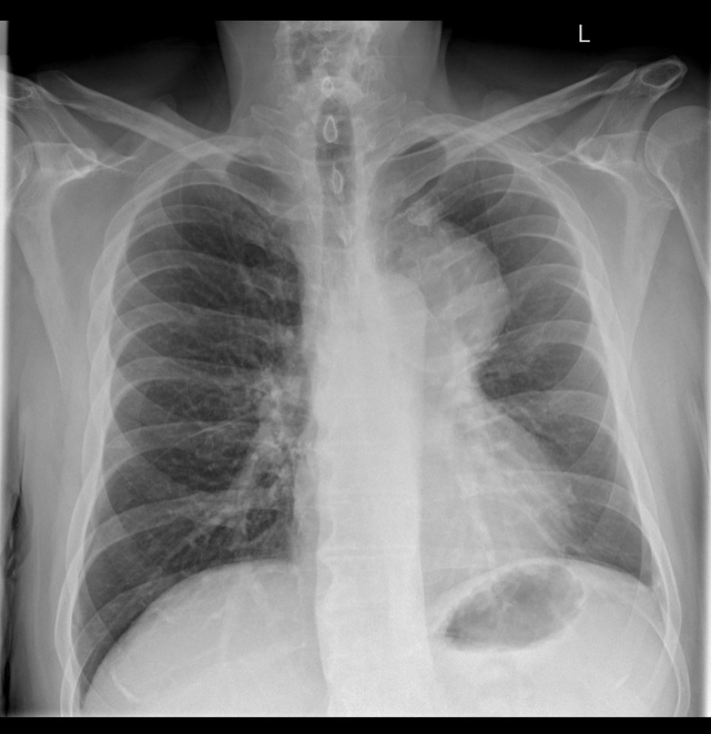 Chest radiography on initial presentation: X-ray showing a left upper-lobe mass adjacent to the aortic knob, measuring approximately 7.5 cm.