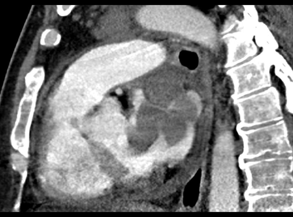 Computed tomography angiography (CTA) of the chest on initial presentation, sagittal view: Image showing the extent of the tumor thrombus occupying the left atrium with invasion originating from the pulmonary veins.