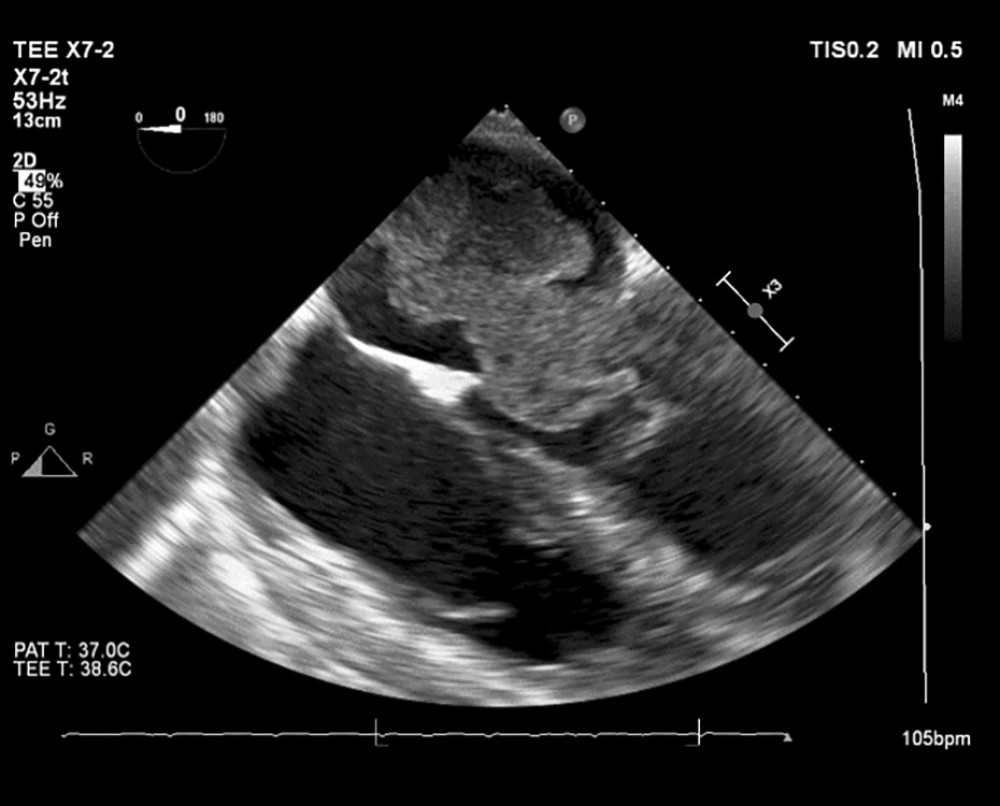 Transesophageal echocardiography (TEE) on initial presentation: Tumor thrombus invading the left atrium and prolapsing into the left ventricle during diastole.