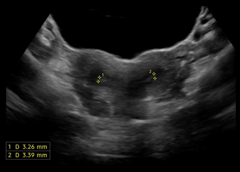 Didelphys uterus on pelvic ultrasoundPelvic ultrasound showing 2 separate endometrial cavities, confirming uterine didelphys. The uterus is anteverted and normal in size.