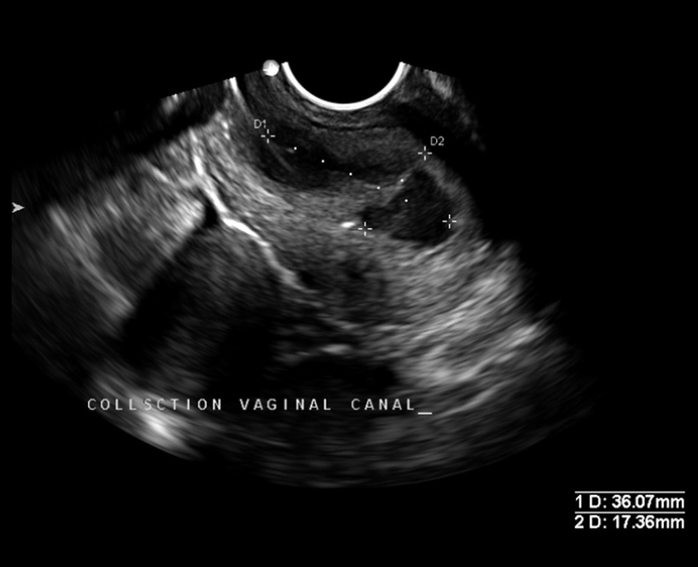 Vaginal fluid collection on ultrasoundUltrasound image showing a fluid collection within the vaginal canal measuring 36.0×17.3 mm, indicative of possible obstruction or hematocolpus.