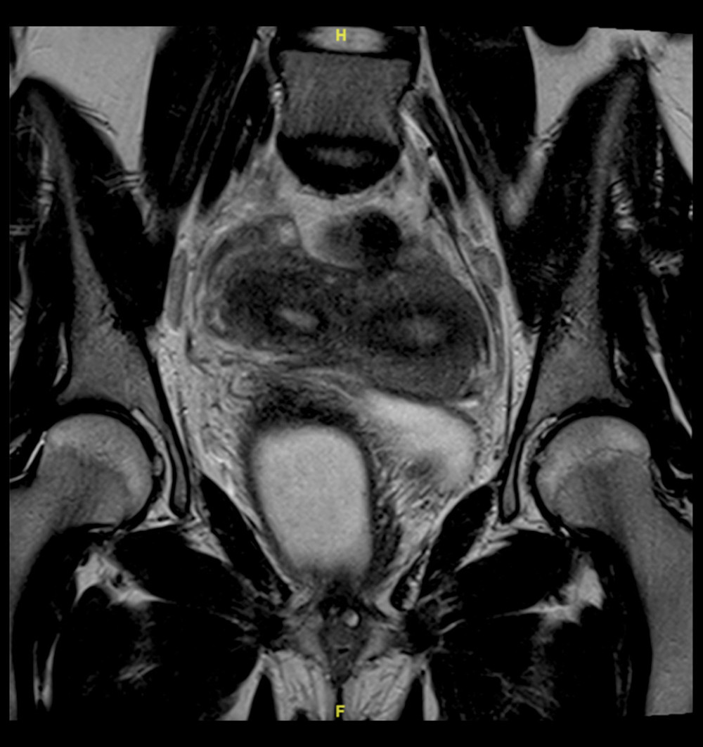 Duplicated uterus and vagina on pelvic magnetic resonance imaging (MRI)MRI showing a didelphic uterus with 2 uterine cavities and 2 cervices. A vertically-oriented vaginal septum is also visible, confirming a duplicated vagina and explaining the associated vaginal fluid collection.