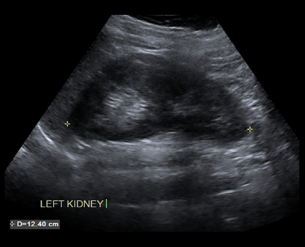 Solitary left kidney on renal ultrasoundRenal ultrasound showing a single left kidney of normal size (12.40×5.86 cm) and echogenicity. No right kidney is visualized.