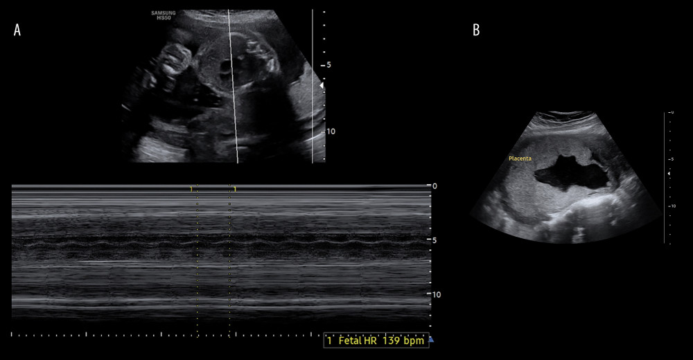 Ultrasound images(A). Ultrasound showing fetal heart rate of 139 beats per minute within an intrauterine gestational sac. (B) Ultrasound showing placenta attached to the anterior uterine wall.