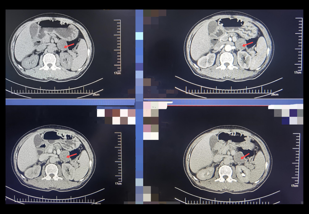 Contrast-enhanced computed tomography axial image demonstrating a 3-cm hyper-enhancing ectopic adrenal lesion (arrow) situated between the pancreatic tail and left adrenal remnant.
