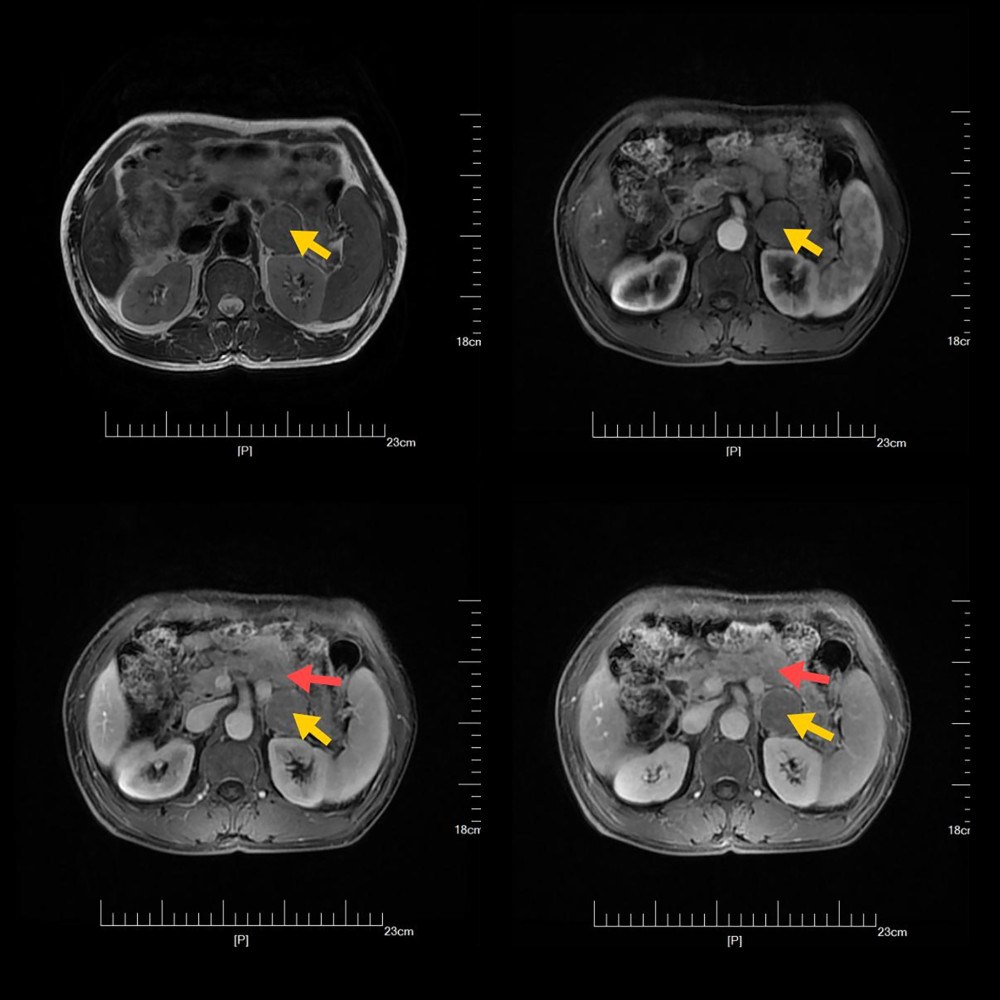 Magnetic resonance imaging T2-weighted coronal image showing a hyperintense mass (arrow) located between the lower margin of the pancreas and the lateral branch of the left adrenal gland.
