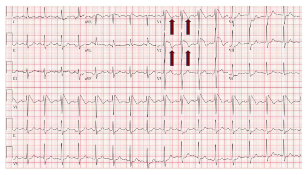 Electrocardiogram on admission showing ST elevation in leads V1 and V2 with inverted T waves.