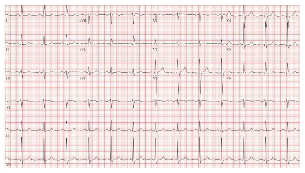 Electrocardiogram pathology resolved, and at discharge the patient had normal sinus rhythm.