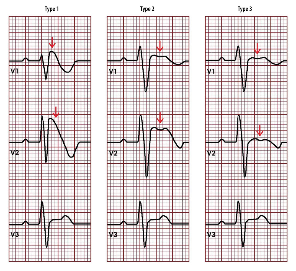Schematic of Brugada pattern subtypes. Subtype 1 shows a coved ST segment elevation at the thick red line of ≥2-mm in one or more chest leads (V1 to V3), followed by an inverted T wave. Subtype 2 has ≥0.5-mm ST-segment elevation in one or more precordial leads, followed by a saddle-back morphology (thick red arrow) to the ST elevation. Subtype 3 can demonstrate either coved or saddleback (thin red line) morphology, but it is consistently <2-mm ST-segment elevation.