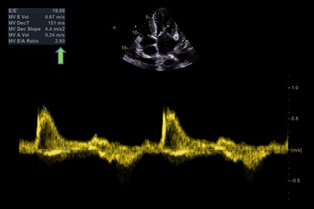 Echocardiographic findings showing restrictive filling pattern with E/E’: 19.88 and an E/A ratio >2 (arrow), a hallmark of cardiac amyloidosis.