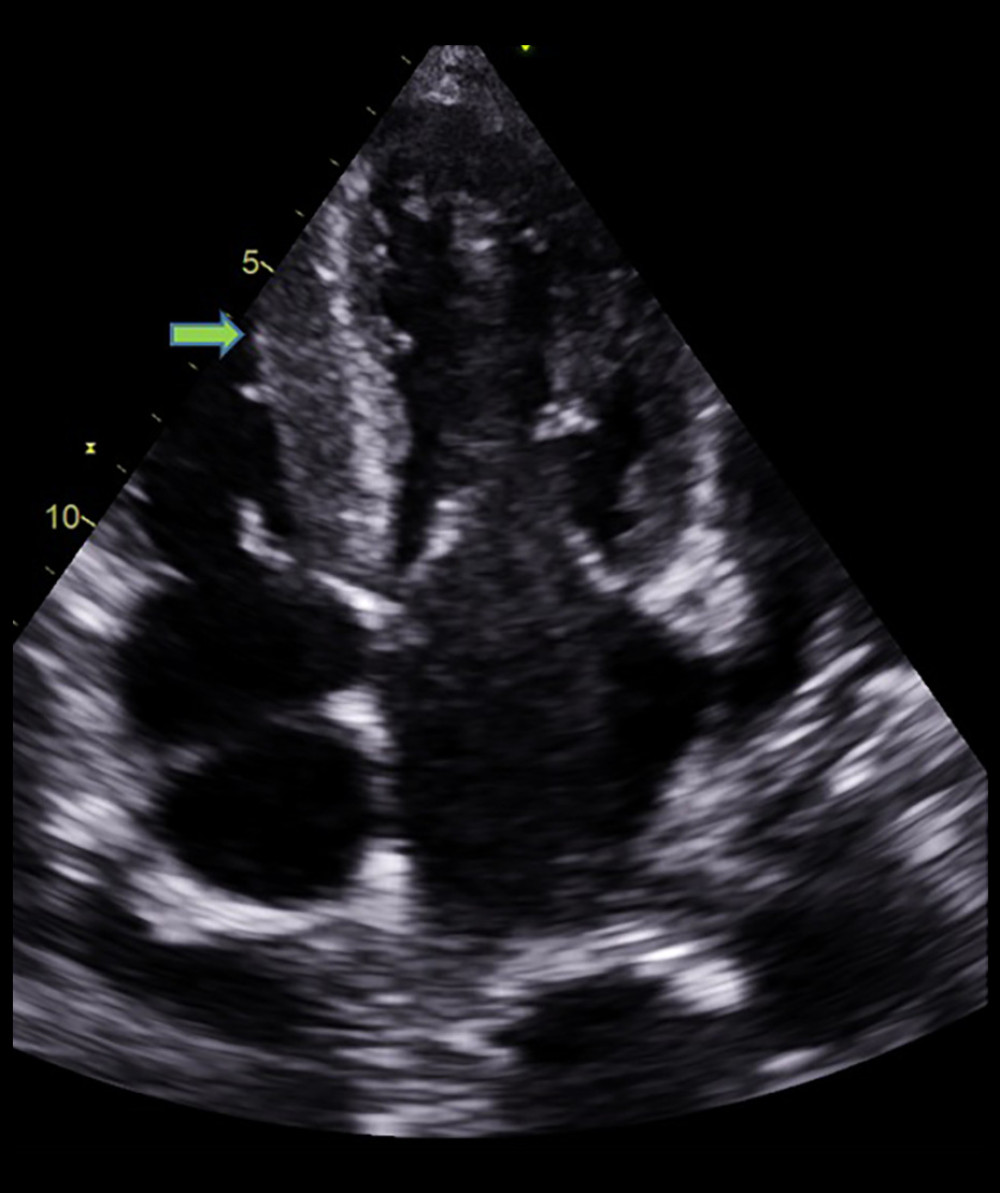Echocardiographic finding showing right ventricle hypertrophy (arrow) and spontaneous echo contrast in left atrium.
