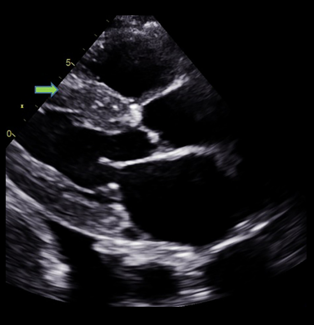 Echocardiographic finding showing left ventricular hypertrophy (arrow) with speckled myocardial appearance and pleural effusion.
