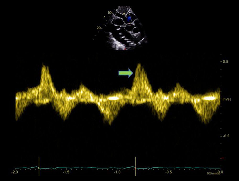 Echocardiographic finding showing systolic flow reversal (arrow) in the hepatic vein indicative of severe tricuspid regurgitation.