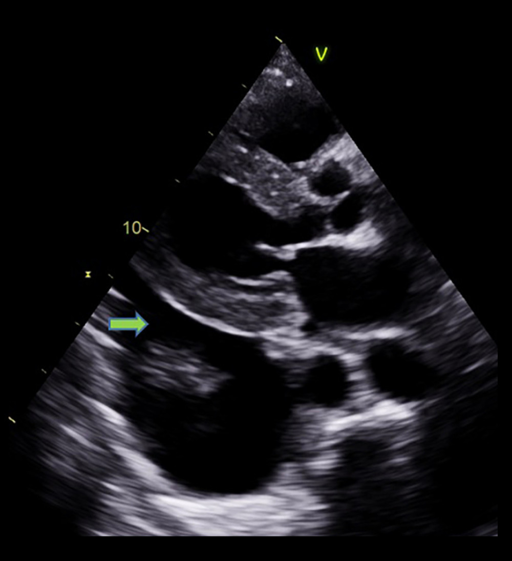 Mild pericardial effusion and significant pleural effusion (arrow).
