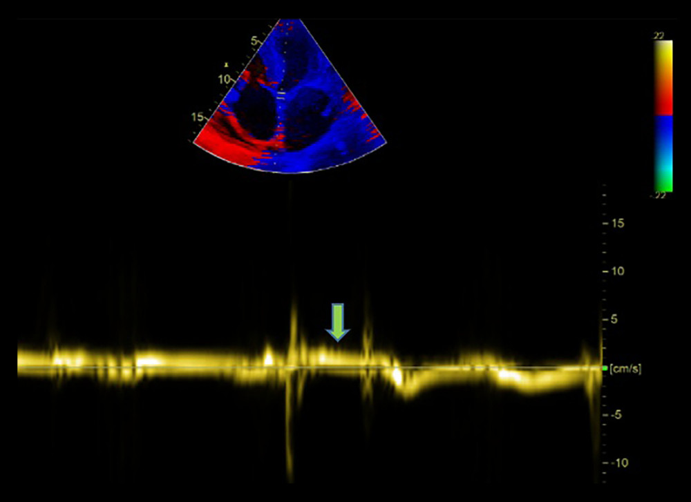 Very low septal E’ (arrow).