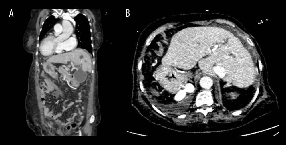 Preoperative imaging demonstrating situs inversus totalisThe left panel shows a coronal computed tomography view, and the right panel shows an axial view. The liver is visualized on the left side and the spleen on the right, consistent with complete mirror-image reversal of thoracic and abdominal organs.