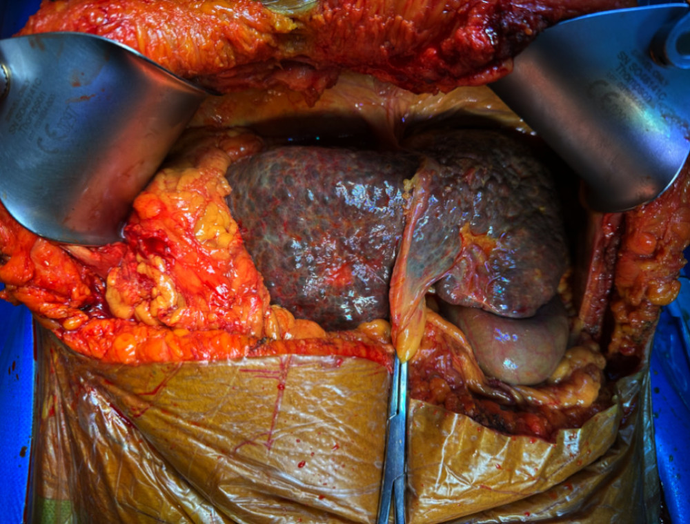 Intraoperative confirmation of situs inversus totalisSurgical view showing reversed organ orientation, with the liver located in the left upper quadrant and the stomach and spleen on the right. No vascular anomalies were observed.