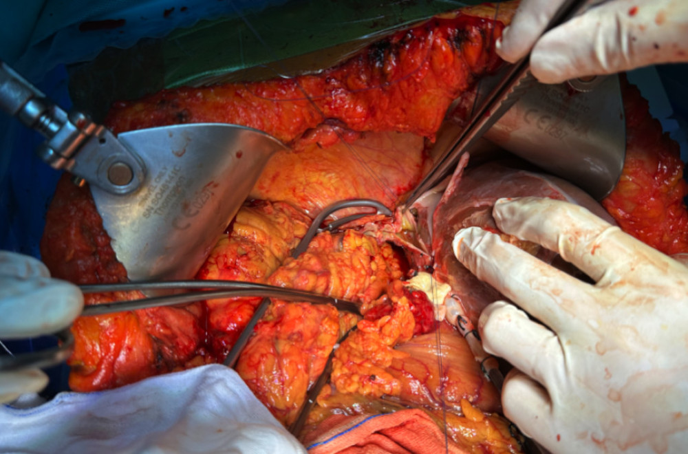 Modified piggy-back technique for venous outflow reconstructionThe donor suprahepatic inferior vena cava was anastomosed to the recipient inferior vena cava in an end-to-side fashion using a wide triangular opening, allowing for tension-free venous drainage in the context of reversed anatomy.