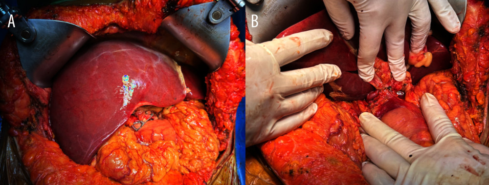 Biliary reconstruction and final graft positioning(A) Intraoperative view of the donor liver prior to bile duct reconstruction. (B) Final view of the hepatic hilum showing completed anastomoses of the hepatic artery, portal vein, and bile duct, with no signs of twisting or compression.