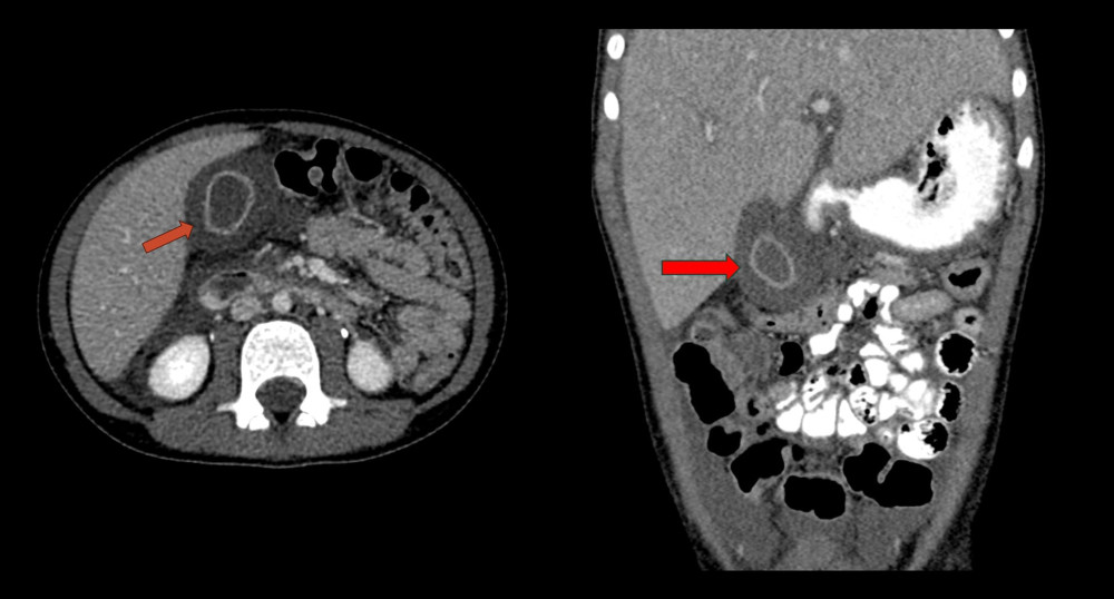 Computed tomography scan of the abdomen. The gallbladder (arrow) is distended (6.5 cm length). The gallbladder wall is diffusely thickened and edematous (1.3 cm thickness) with gallbladder mucosa hyperenhancement. No radio-dense calculi or high-density bile are seen within the gallbladder lumen.