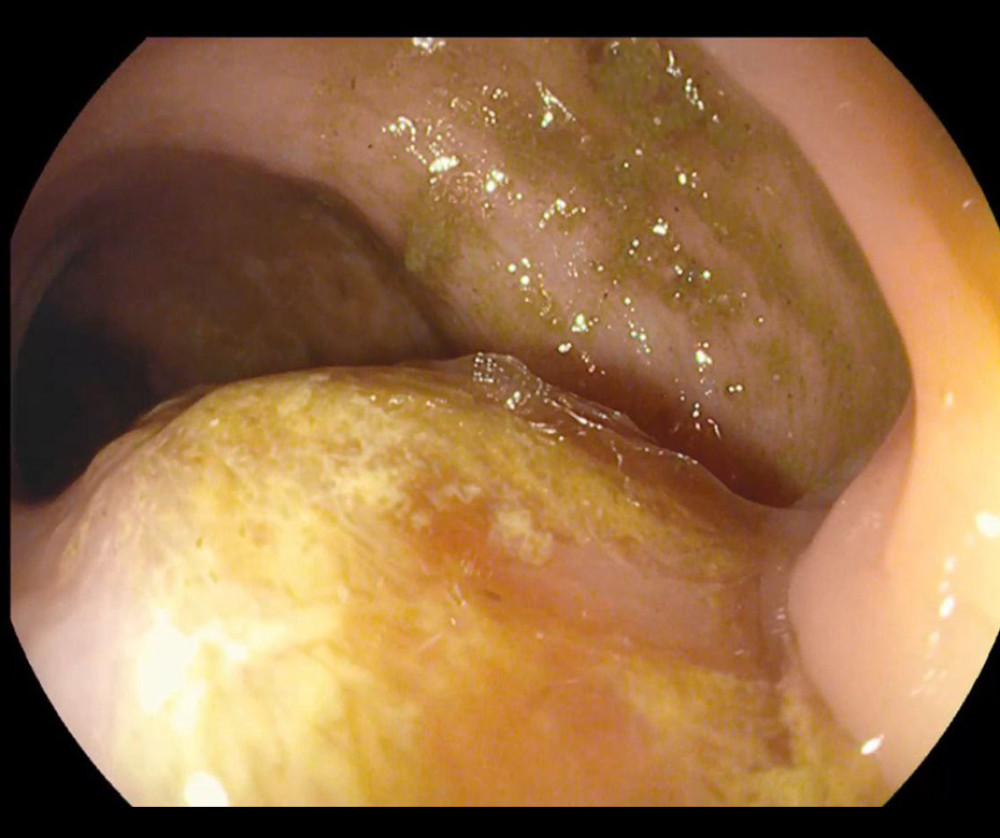 Colonoscopy image showing multiple yellowish lesions in the sigmoid colon, thought to be either inflammatory or hyperplastic in origin.