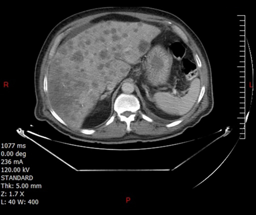 Abdominal CT showing numerous metastatic liver lesions.