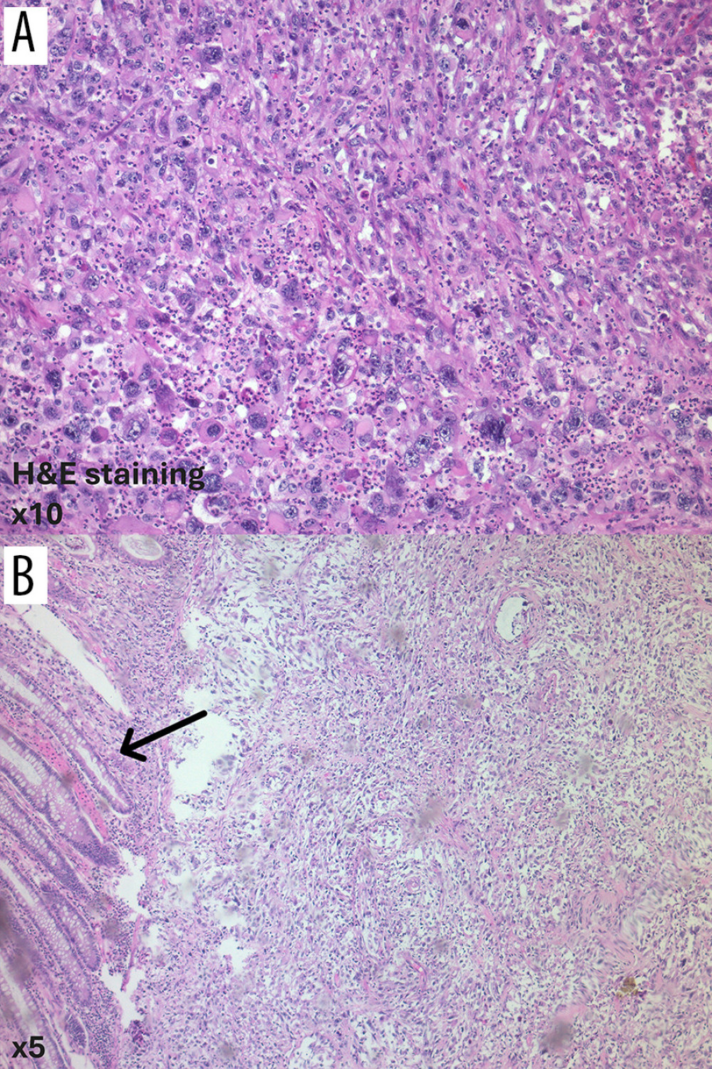 (A, B) Pleomorphic cells in the tumor along with infiltration of the adjacent mucosa, showing its mesenchymal phenotype with high capacity of invasion. The black arrow indicates the mucosal structure with glandular epithelium.