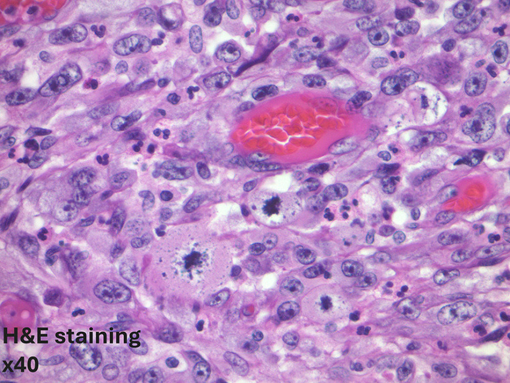 Spindle cell component of the tumor.