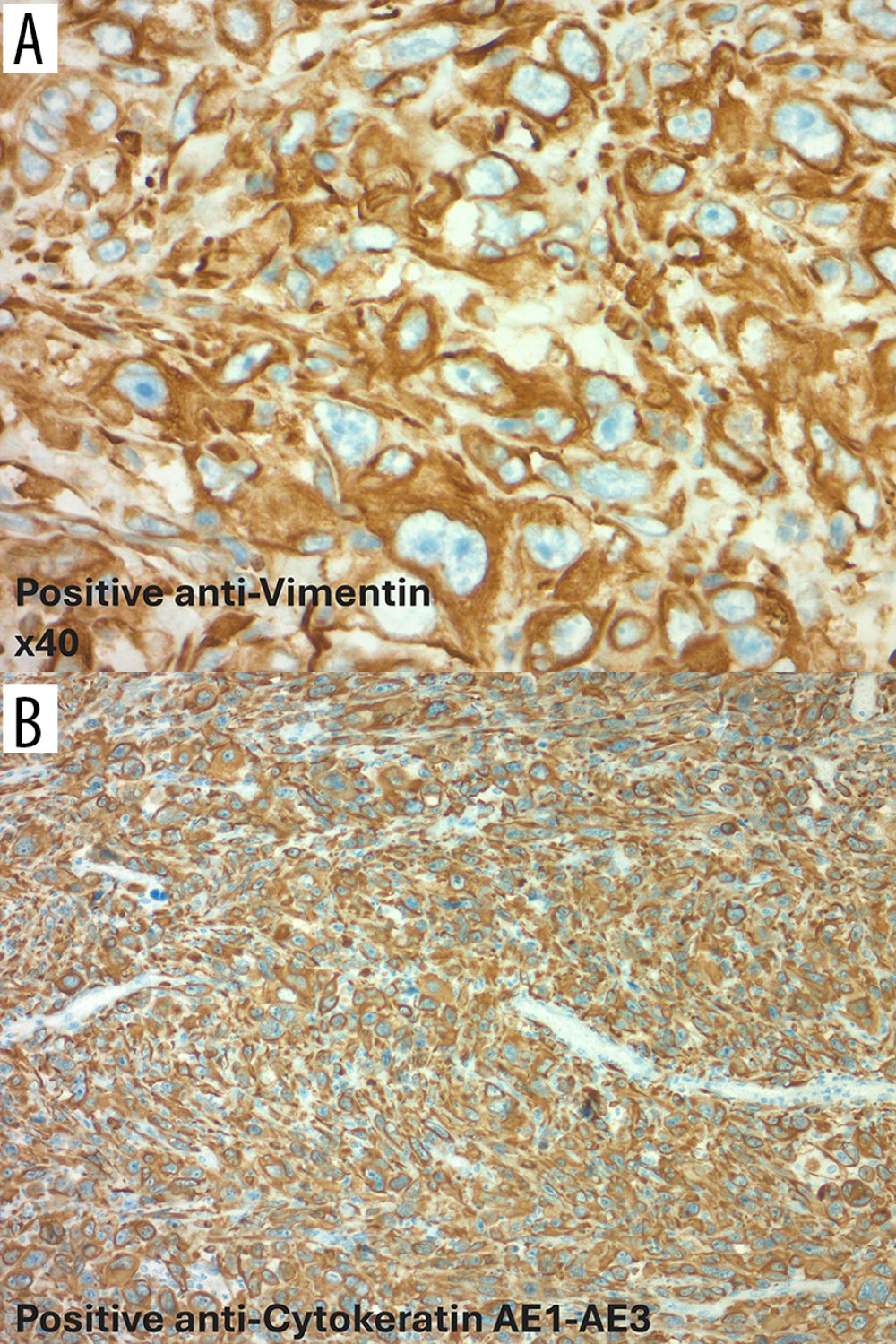 (A, B) Strong immunoreactivity for vimentin in the spindle cell component and cytokeratin in the epithelial cells.