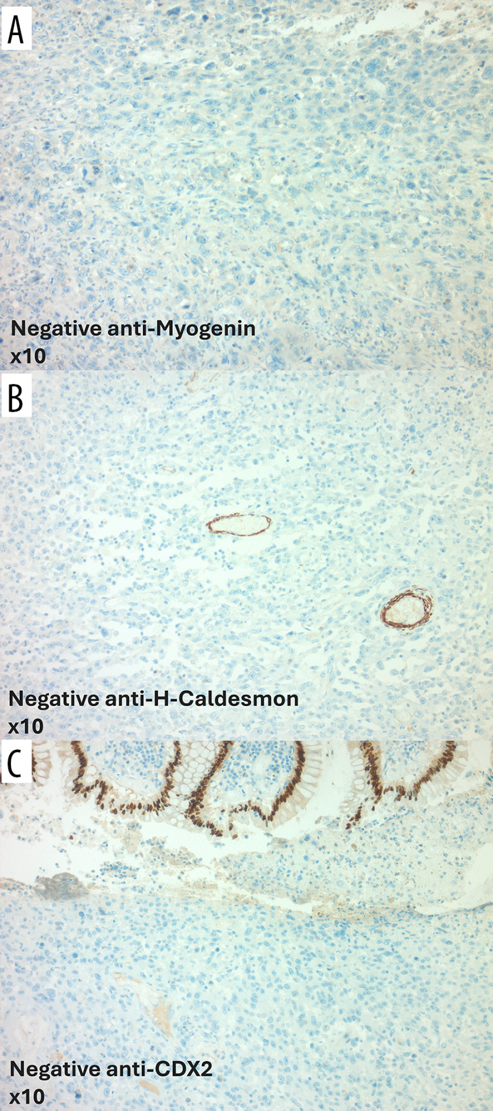 Absence of immunoreactivity for myogenin, caldesmon H, and CDX2, which ruled out the possibility of rhabdomyosarcoma.