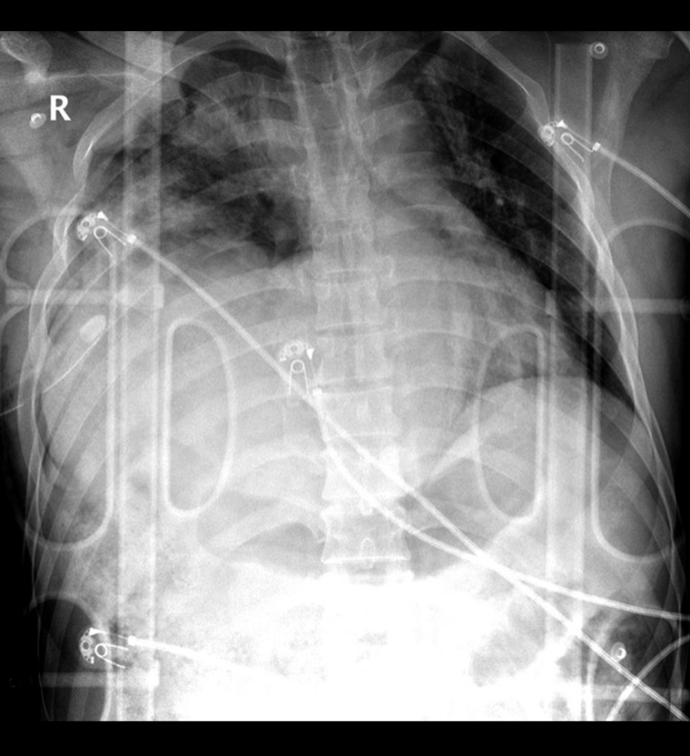 Chest radiograph showing right pneumohemothorax and intercostal chest tube in place. Note: The patient was not positioned well for the film.