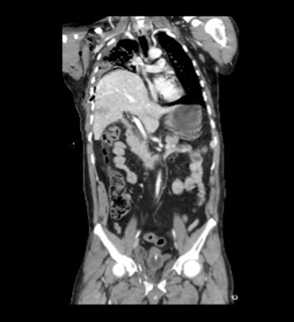 Coronal computed tomography scan showing the herniation of the liver to right hemithorax with intercostal chest tube noted in the liver parenchyma.