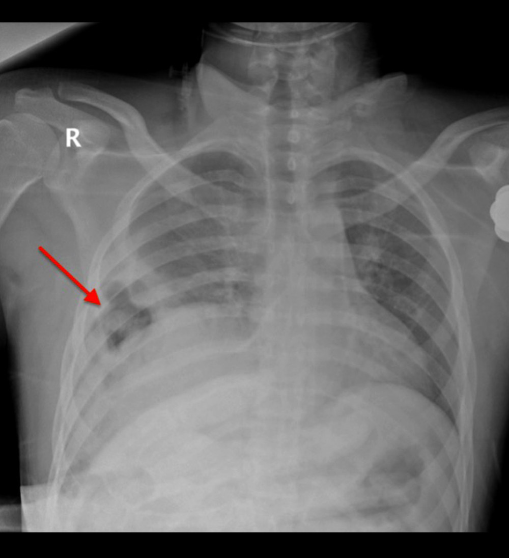 Chest radiograph showing lucent bowel loop (arrow) within the right chest coupled with hemothorax.