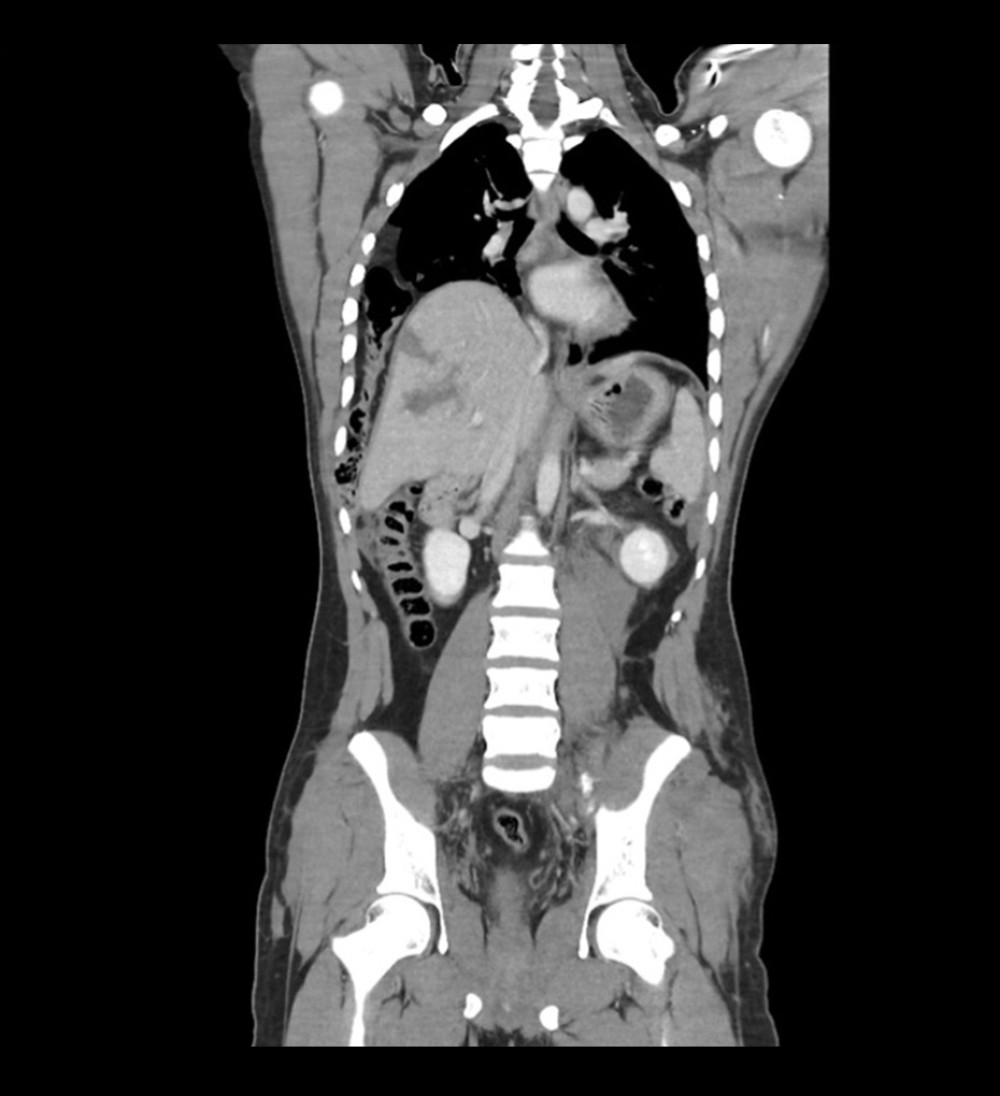Coronal computed tomography showing herniation of the right hepatic lobe and hepatic flexure of colon to the right hemithorax.