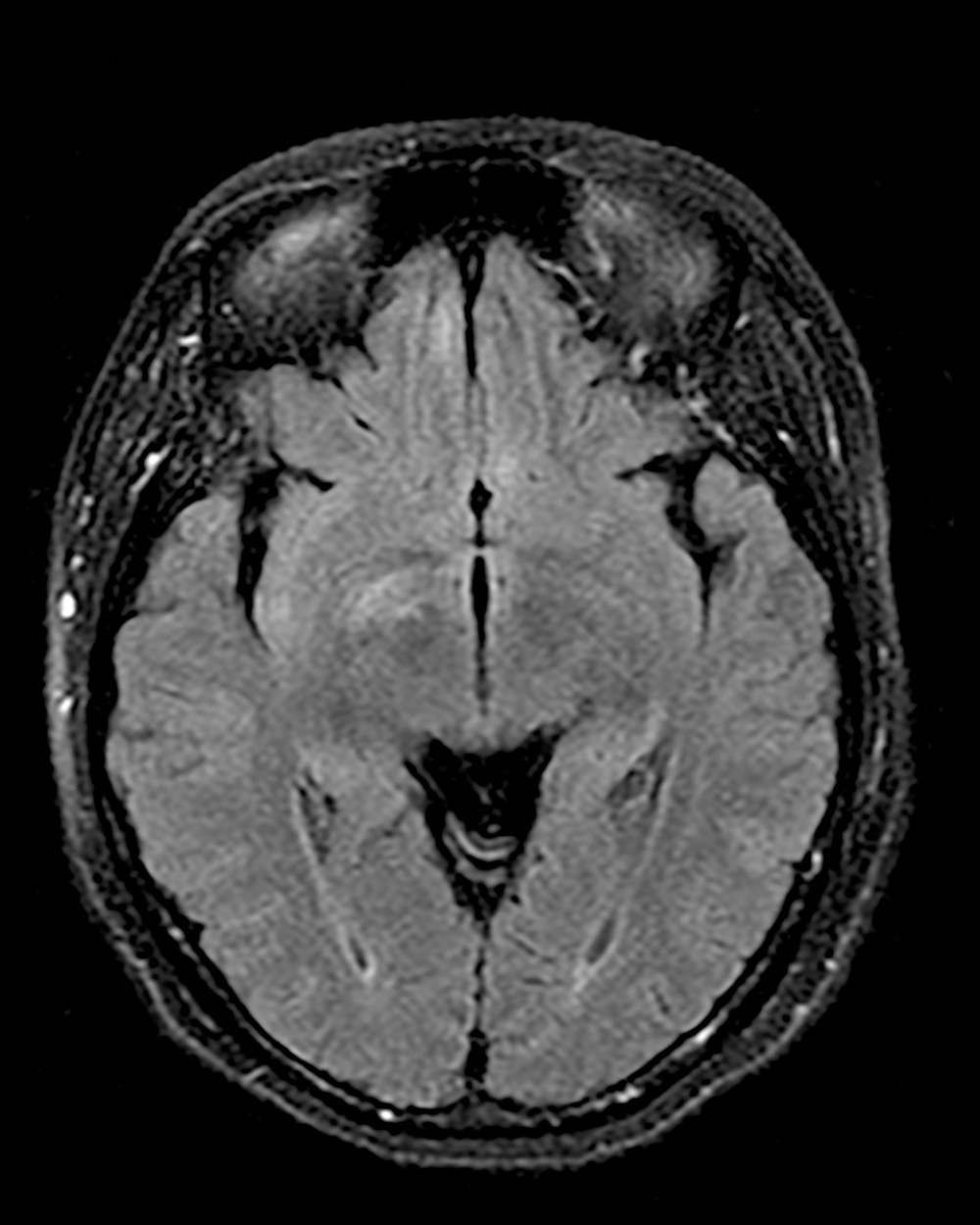 Fluid-attenuated inversion recovery sequence MRI of the brain showing non-enhancing T2 hyperintensities in the right gangliocapsular region, both frontal lobes, and the right insular cortex.