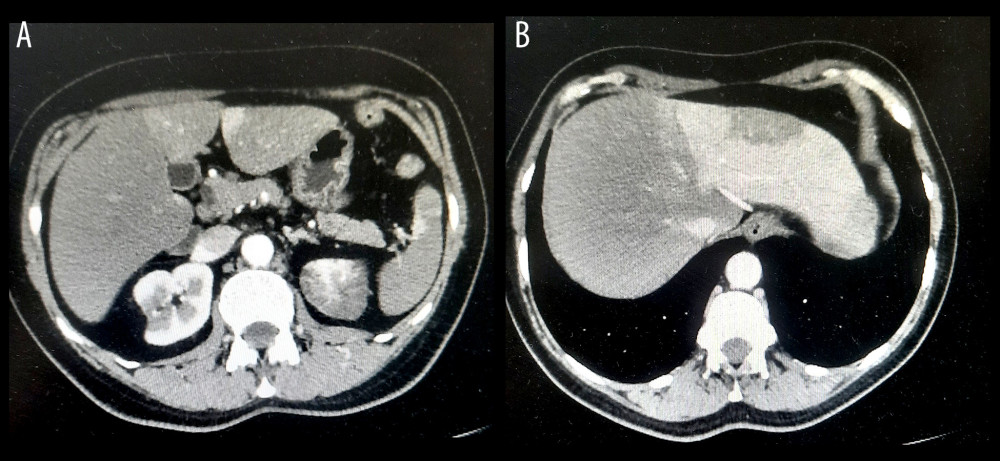 Left kidney ischemia (A) and right hepatic ischemia (B) observed on the CT performed on the first day of hospitalization.
