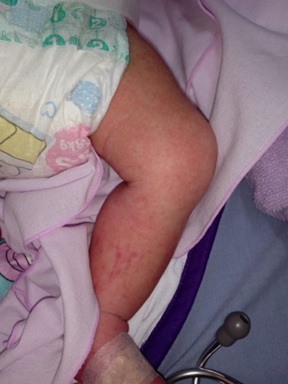 Convalescent maculopapular rash on the neonate’s left legA maculopapular rash is visible on the left lower extremity of the 4-day-old neonate during the convalescent phase of dengue infection. This type of rash is commonly associated with dengue virus and typically appears as flat or raised red lesions.