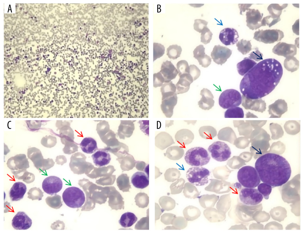 Bone marrow biopsy in Patient A. Under 4× magnification (A), a high cell density was observed, with prominent granulocytic proliferation – predominantly neutrophils – indicating active myeloid hyperplasia. The remaining images at 40× magnification (B–D) reveal an increased number of segmented neutrophils (red arrows), some exhibiting vacuolation (blue arrows), along with metamyelocytes (green arrows) and promyelocytes (black arrows). Overall, the bone marrow demonstrated active hematopoiesis with marked proliferation of segmented and immature granulocytes, without any abnormal increase in blasts or nuclear atypia. Key diagnostic features of a leukemoid reaction include a markedly elevated neutrophil count and reduced but morphologically normal erythroid lineage cells, in contrast to leukemia, which typically shows a high proportion of blasts and aberrant nuclear chromatin. The annotations showing segmented neutrophils, neutrophil vacuolation, and immature granulocytes clearly illustrate microscopic hallmarks of a leukemoid reaction, supporting the clinical diagnosis.