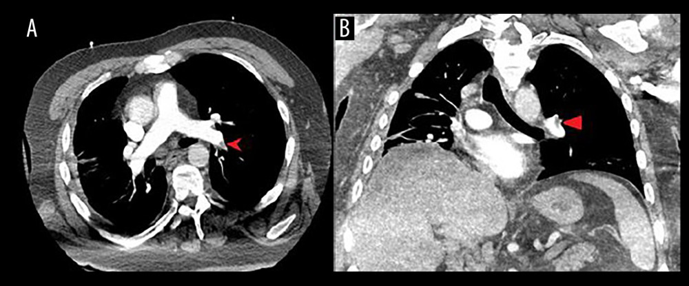 (A) Axial view of the chest showing a computed tomography angiography (CTA) with left-sided pulmonary embolism (left arrow). (B) Coronal view of the chest showing the same CTA, for comparison.