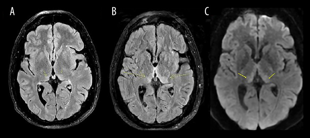 (A, B) Axial Fluid-Attenuated Inversion Recovery (FLAIR) magnetic resonance imaging (MRI) brain sequences with bilateral medial-thalamic changes and tectal/periaqueductal grey midbrain signal changes (yellow arrows). (C) Axial diffusion weighted imaging (DWI) brain MRI demonstrating corresponding areas of restricted diffusion.