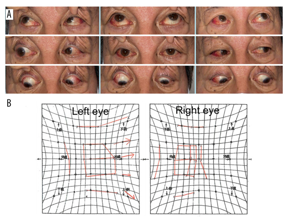 Preoperative extraocular movement test. (A) At the initial medical examination, mild limitation of the right eye’s abduction can be observed.(B) Hess chart at 1 month after the initial medical examination, showing persistent limitation of right eye’s abduction.