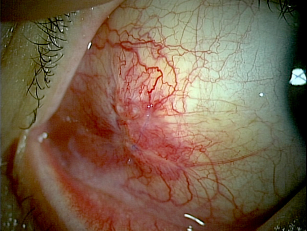 External eye photograph at initial medical examination. A scar can be observed near the insertion of the lateral rectus muscle of the right eye.