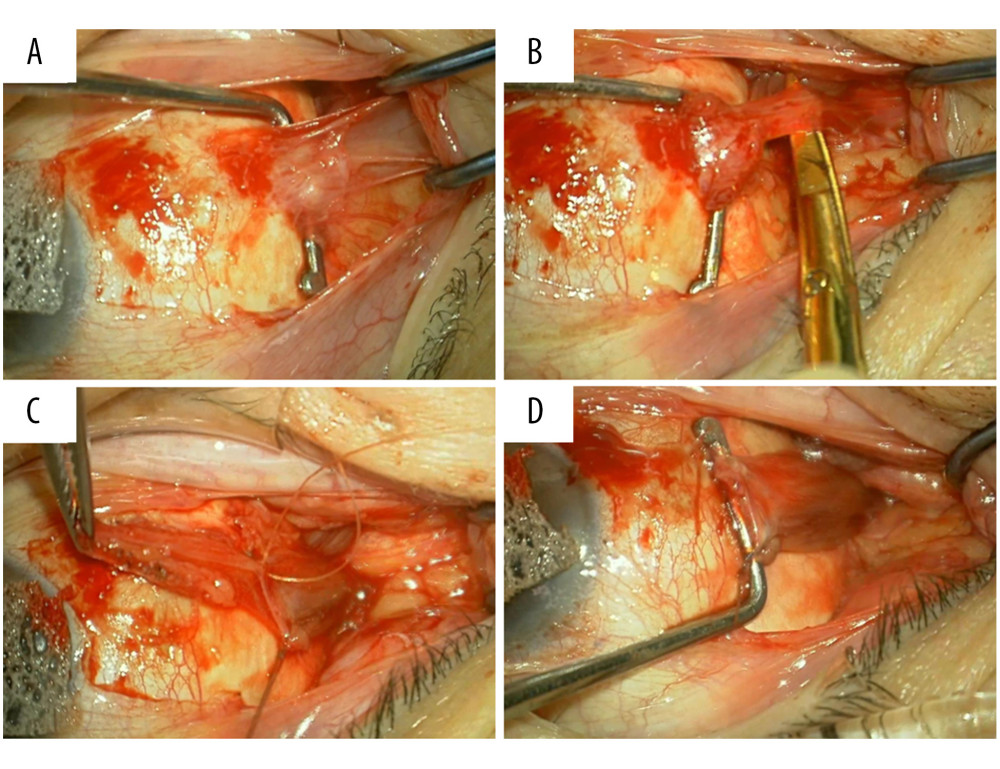 Right lateral rectus muscle advancement. (A) Fat adhesion and scar formation observed in the lateral rectus muscle insertion area. (B) A translucent membrane tissue extends posteriorly from the muscle insertion. (C) The lateral rectus muscle belly posterior to the membrane tissue has been sutured, and the membrane tissue has been detached. The excised membrane tissue is held in the forceps. The muscle belly is posterior to the suture. (D) The muscle belly has been sutured to the sclera 7 mm from the corneal limbus.