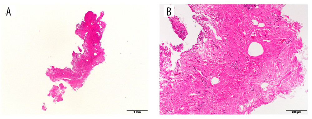 Hematoxylin and eosin staining image of excised tissue. (A) Low-power view of the excised tissue. (B) High-power view of the same tissue. The tissue consists of collagen fibers and adipose tissue, with poor vascularity and no muscle fibers.