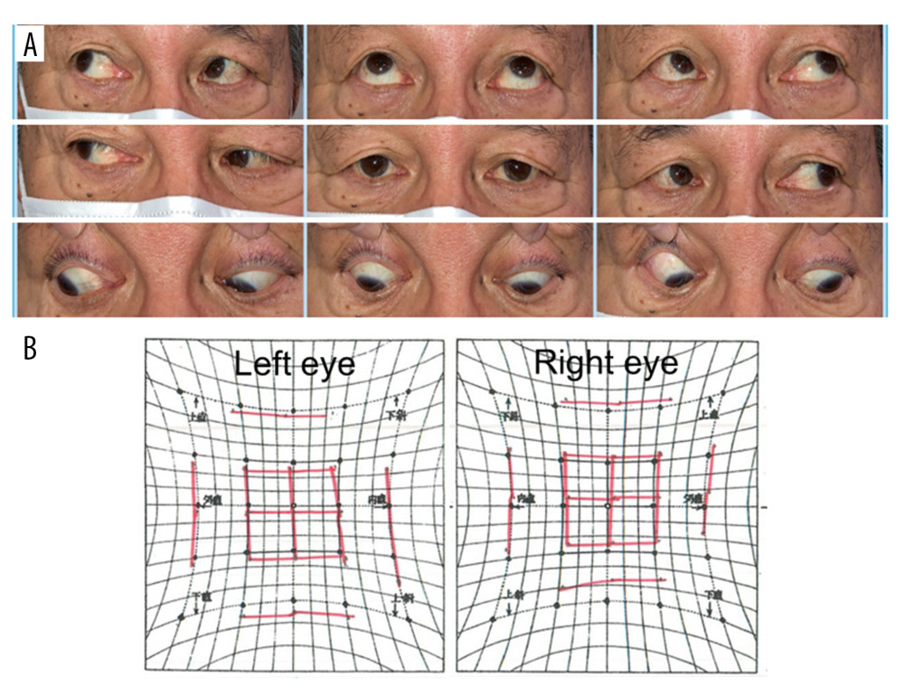 Extraocular movements 1 year after surgery. (A) Extraocular movement photograph. (B) Hess chart showing the improvement in the limitation of the right eye’s abduction and the adduction after surgery.
