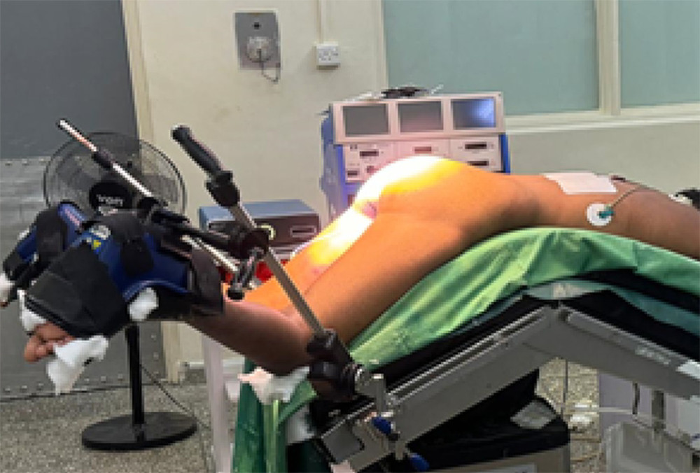 Patient positioned in a modified prone jack-knife position with both legs suspended.