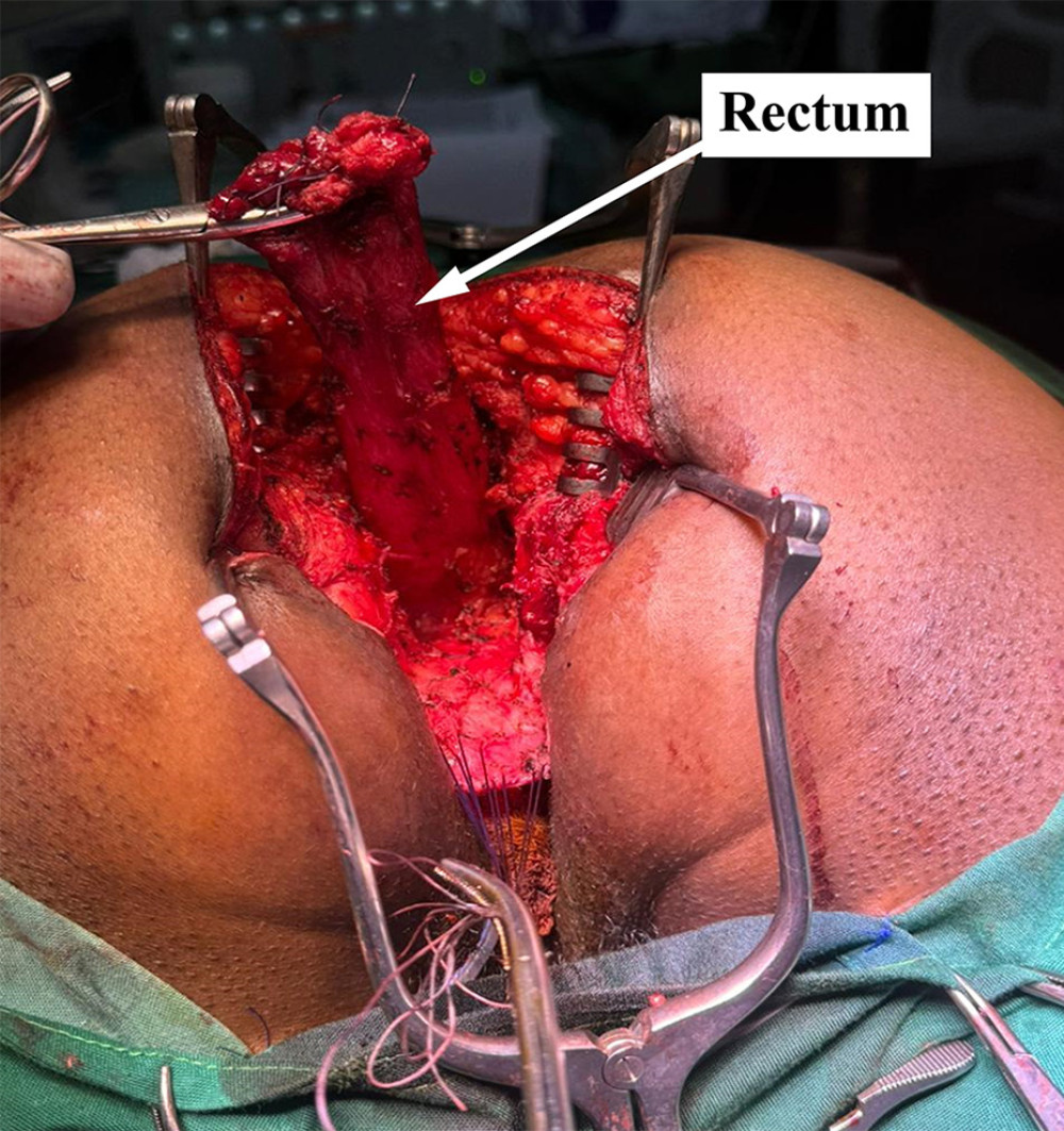 Intraoperative photograph showing the rectum (arrow) after complete circumferential dissection with adequate length achieved to allow tension-free anorectoplasty.