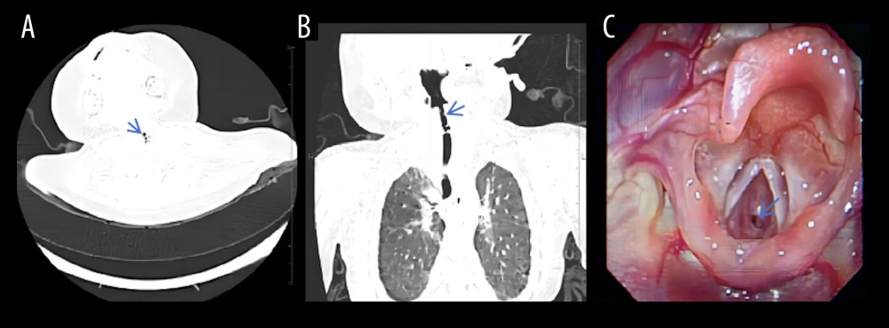 Neck and chest computed tomography scans (A, B) demonstrated localized subglottic stenosis. Fiber laryngoscopy (C) revealed severe subglottic stenosis with a pinhole-sized lumen.