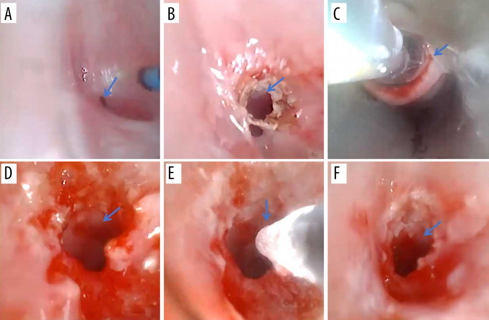 Bronchoscopic interventional treatment of subglottic stenosis and postoperative airway. (A) Bronchoscopy before therapy revealed airway stenosis. (B–E) Holmium laser, balloon dilation, and cryotherapy were performed to treat the stenotic region. (F) After the first intervention, the airway lumen was considerably enlarged.